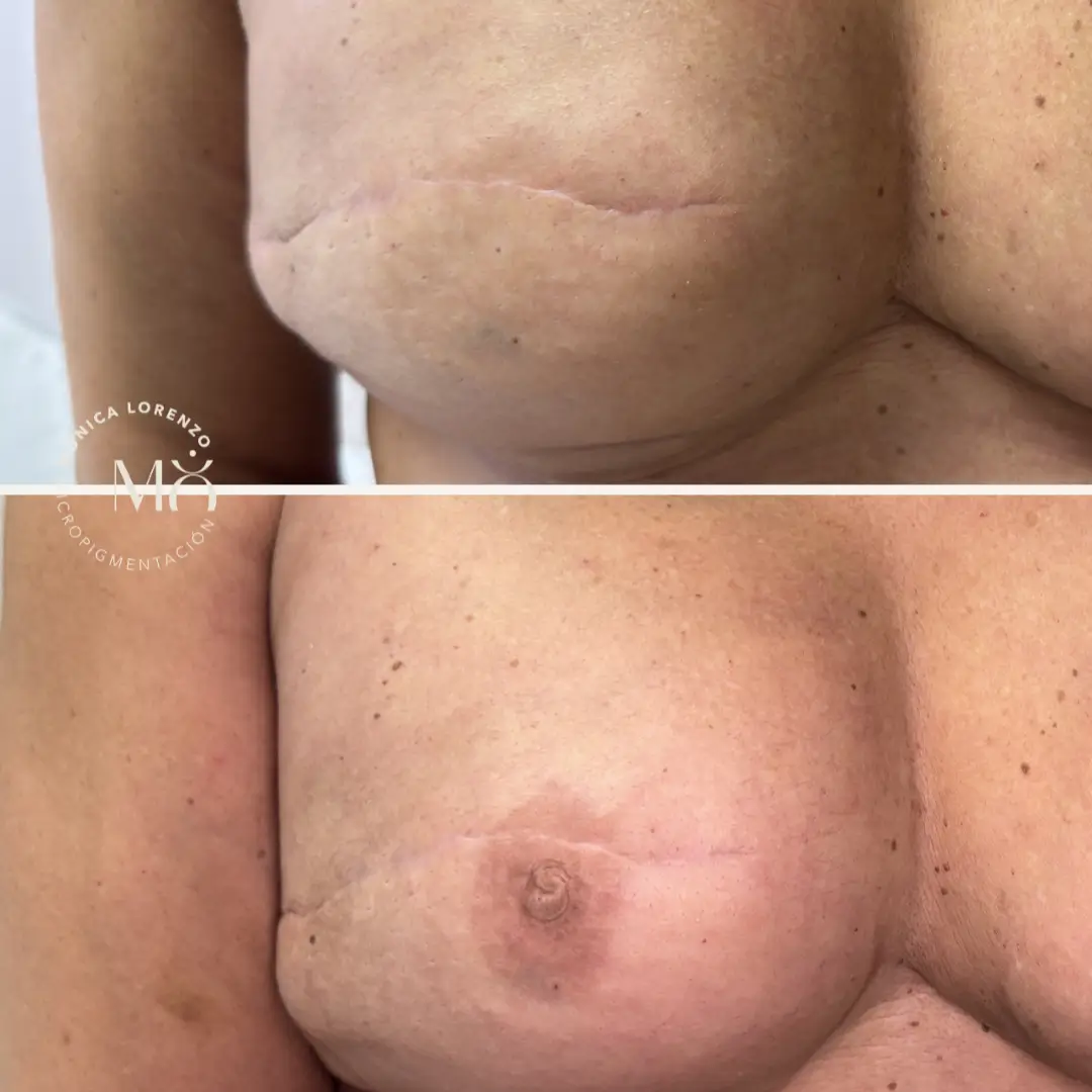 3D Areola Reconstruction & Periareolar Scar Camouflage - Trainer Monica Lorenzo - imagine 3