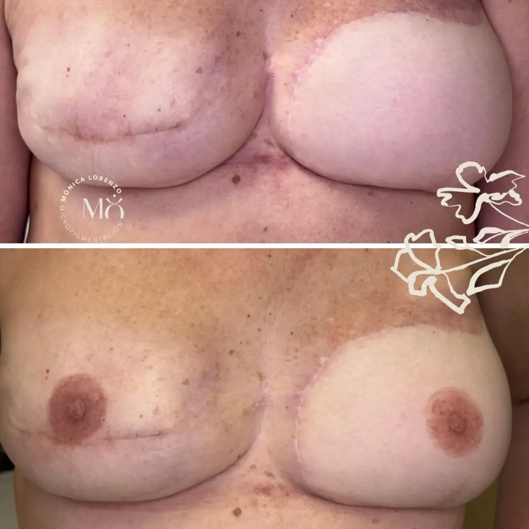 3D Areola Reconstruction & Periareolar Scar Camouflage - Trainer Monica Lorenzo - imagine 4